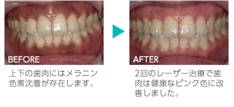 カムブリーチング